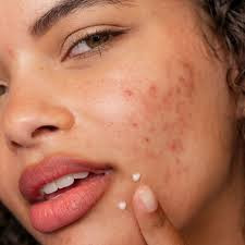 Teen skin