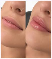 Lip Augmentation