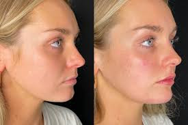 Advanced facial transformation using dermal filler