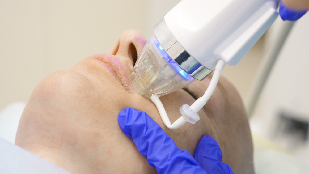 RF Fractional micro-needling