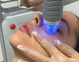 RF Fractional micro-needling x6 treatments