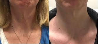 RF Fractional micro-needling neck