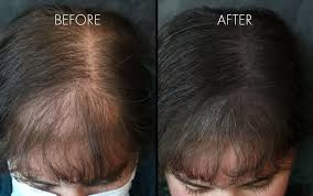 Micropigmentation