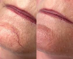Spider Vein Removal