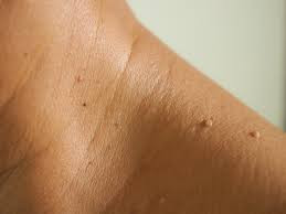 Skin tag removal - multiple