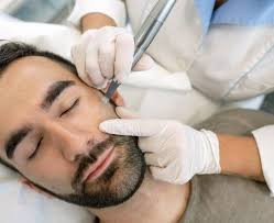 Biorepeel + micro needling + dermaplane